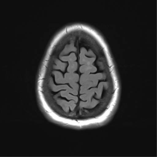 File:Anterior temporal pole cysts (Radiopaedia 46629-51102 Axial FLAIR 24).png