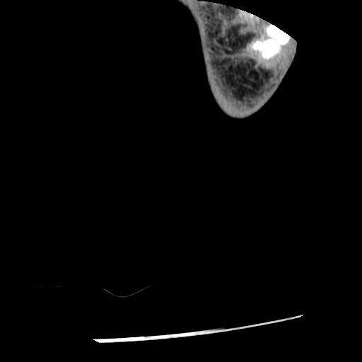 Anterior tibial artery false aneurysm (Radiopaedia 88984-105809 A 281).jpg