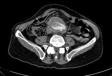 Anterior vertebral scalloping (abdominal aortic aneurysm) (Radiopaedia 66744-76067 F 61).jpg