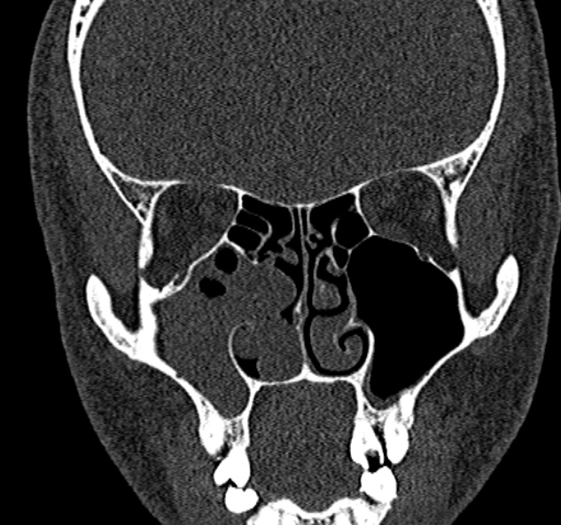 File:Antrochoanal polyp (Radiopaedia 30002-30554 Coronal bone window 40).jpg