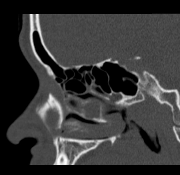 Antrochoanal polyp (Radiopaedia 33984-35202 Sagittal bone window 32).jpg