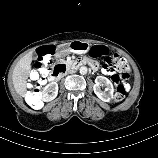 File:Aortic aneurysm and Lemmel syndrome (Radiopaedia 86499-102554 A 39).jpg