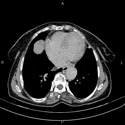 Aortic aneurysm and Lemmel syndrome (Radiopaedia 86499-102554 Axial C+ delayed 3).jpg