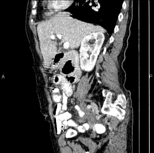 File:Aortic aneurysm and Lemmel syndrome (Radiopaedia 86499-102554 D 31).jpg