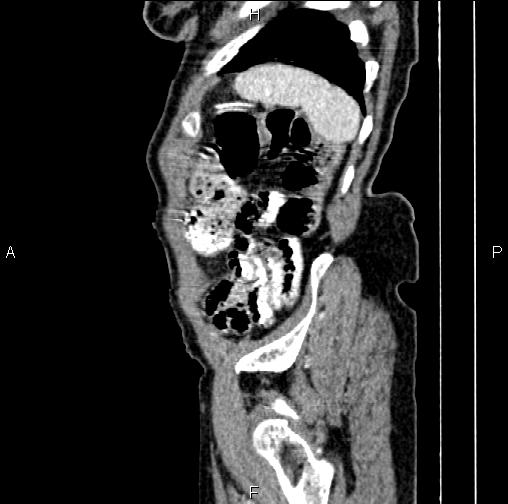File:Aortic aneurysm and Lemmel syndrome (Radiopaedia 86499-102554 D 80).jpg