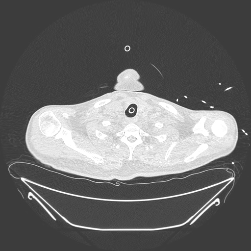 Aortic arch aneurysm (Radiopaedia 84109-99365 Axial lung window 36).jpg