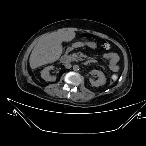 Aortic arch aneurysm (Radiopaedia 84109-99365 Axial non-contrast 336).jpg