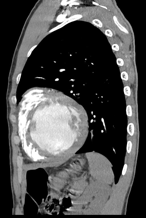 Aortic coarctation with aneurysm (Radiopaedia 74818-85828 B 120).jpg