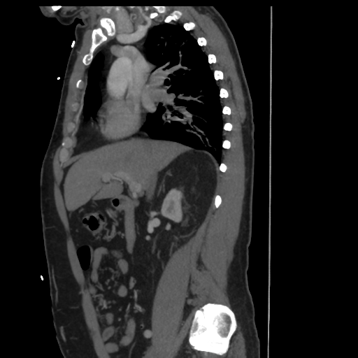 File:Aortic dissection- Stanford A (Radiopaedia 37759-39664 Sagittal C+ delayed 6).png