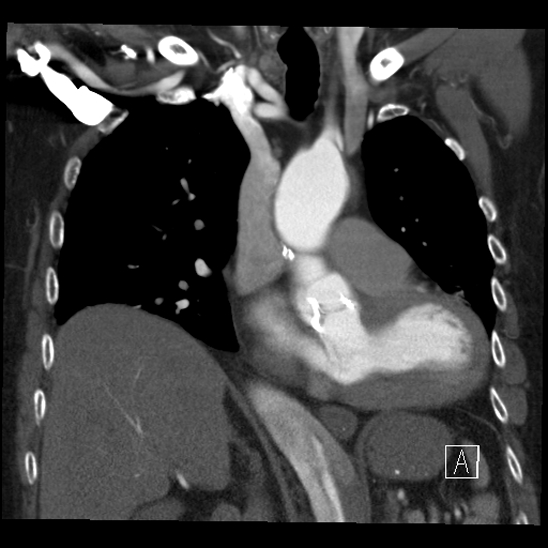 Aortic dissection (CTPA) (Radiopaedia 75506-86750 B 30).jpg