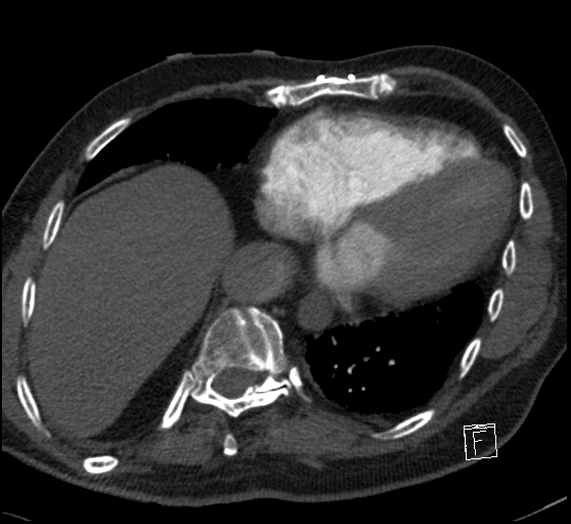 File:Aortic dissection (CTPA) (Radiopaedia 75506-86751 Axial C+ CTPA 103).jpg