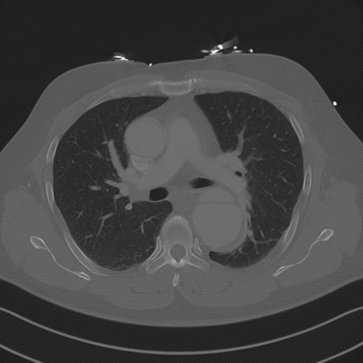 Aortic dissection (Radiopaedia 50763-56234 Axial bone window 48).png