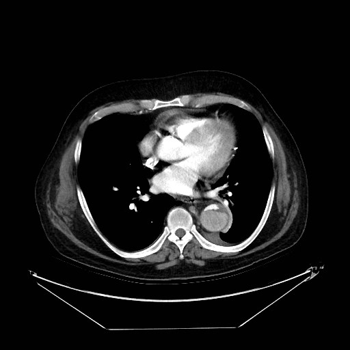 Aortic dissection (Radiopaedia 62562-71000 A 25).jpg