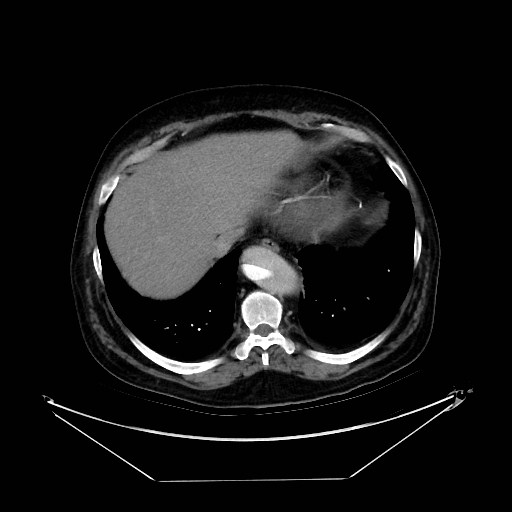 Aortic dissection (Radiopaedia 62562-71000 A 38).jpg
