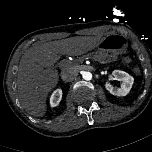 Aortic dissection - DeBakey type II (Radiopaedia 64302-73082 A 96).png