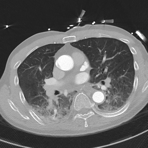 File:Aortic dissection - DeBakey type II (Radiopaedia 64302-73082 Axial lung window 30).png