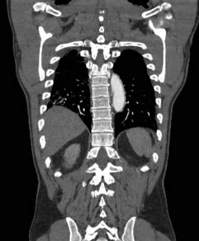 File:Aortic dissection - Stanford type B (Radiopaedia 73648-84437 B 95).jpg