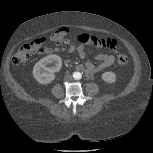 Aortic dissection - Stanford type B (Radiopaedia 88281-104910 A 128).jpg