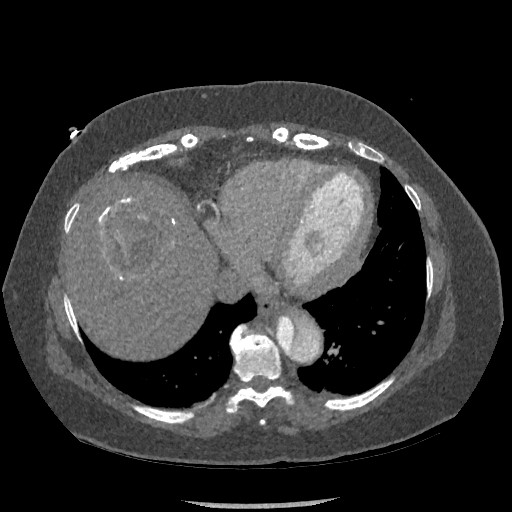 Aortic dissection - Stanford type B (Radiopaedia 88281-104910 A 70).jpg