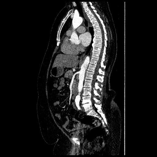 File:Aortic dissection - Stanford type B (Radiopaedia 88281-104910 C 38).jpg