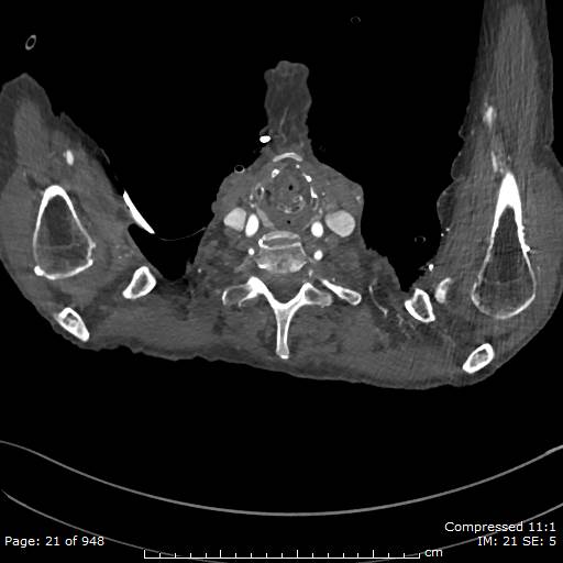 File:Aortic dissection with extension into aortic arch branches (Radiopaedia 64402-73204 B 21).jpg