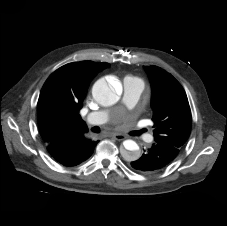 Aortic dissection with rupture into pericardium (Radiopaedia 12384-12647 A 26).jpg