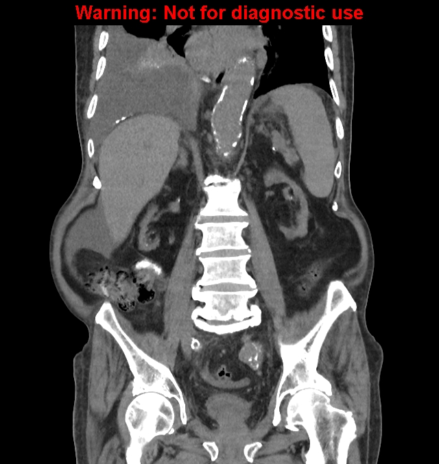 Aortic graft infection (Radiopaedia 44979-48907 non-contrast 31).jpg
