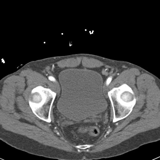 Aortic intramural hematoma (Radiopaedia 31139-31838 B 158).jpg