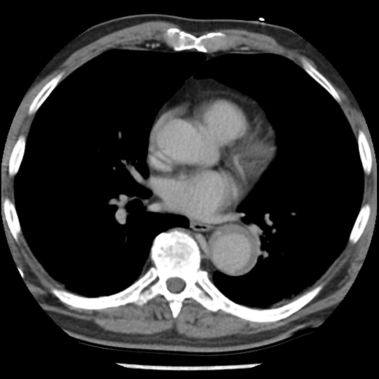 Aortic intramural hematoma (type B) (Radiopaedia 79323-92387 Axial C+ delayed 30).jpg