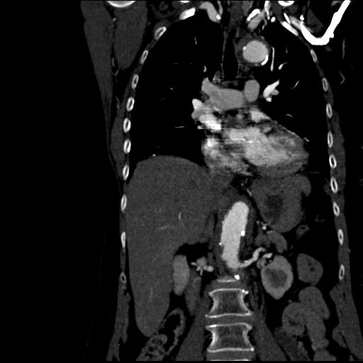 Aortic intramural hematoma from penetrating atherosclerotic ulcer (Radiopaedia 31137-31836 C 32).jpg