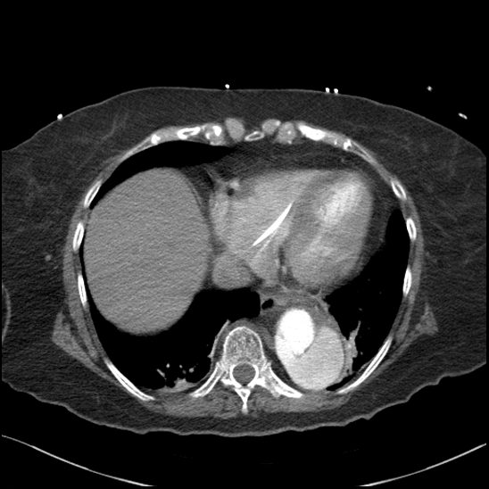 Aortic intramural hematoma with dissection and intramural blood pool (Radiopaedia 77373-89491 B 84).jpg