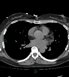 Aortic valve endocarditis (Radiopaedia 87209-103485 Axial non-contrast 58).jpg
