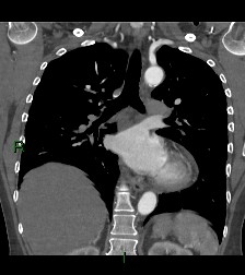 File:Aortic valve endocarditis (Radiopaedia 87209-103485 D 30).jpg
