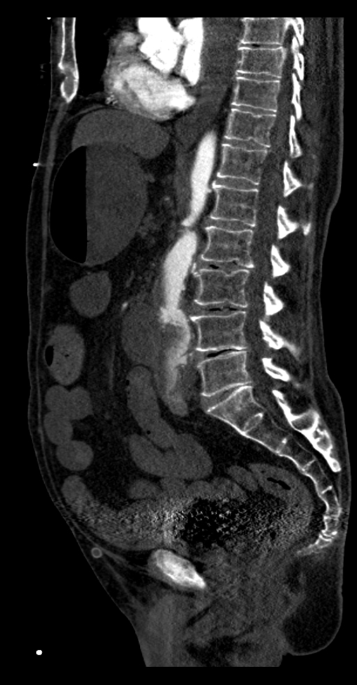 Aortoduodenal fistula (Radiopaedia 75286-86415 F 27).jpg