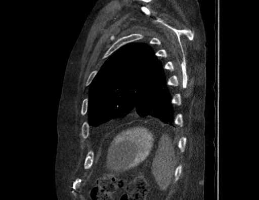 File:Aortoesophageal fistula with endovascular repair (Radiopaedia 73781-84592 Sagittal C+ CTPA 170).jpg