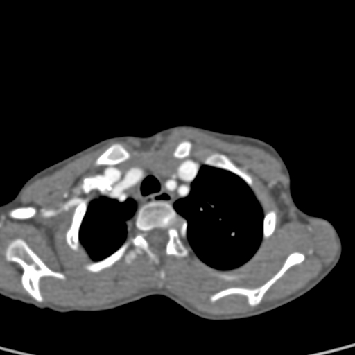 File:Aortopulmonary window, interrupted aortic arch and large PDA giving the descending aorta (Radiopaedia 35573-37074 B 13).jpg