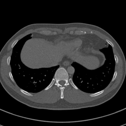 Apical lung mass mimic - neurogenic tumor (Radiopaedia 59918-67521 Axial bone window 66).jpg
