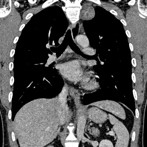 Apical lung mass mimic - neurogenic tumor (Radiopaedia 59918-67521 B 67).jpg