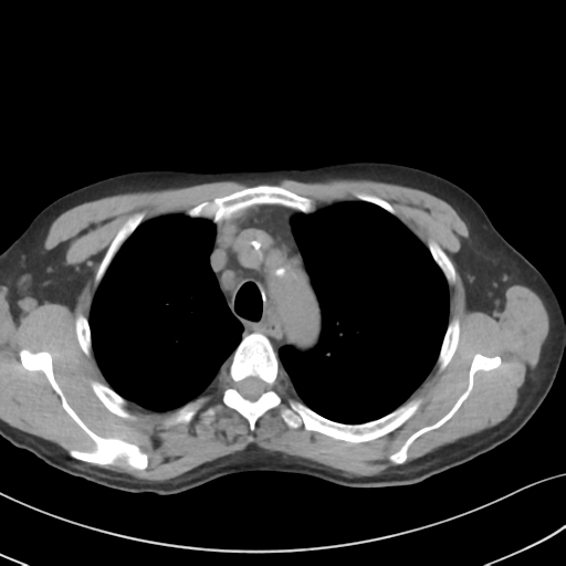Apical pulmonary metastasis (Radiopaedia 46338-50754 B 18).png