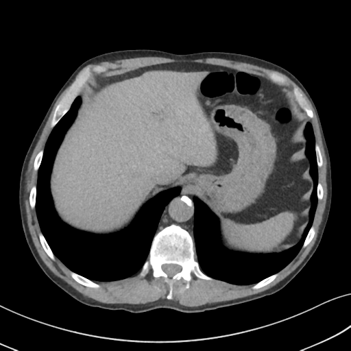 Apical pulmonary metastasis (Radiopaedia 46338-50754 B 56).png