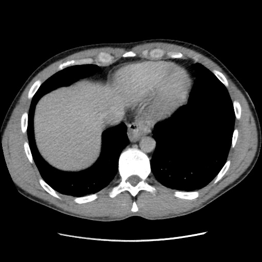 File:Appendicitis complicated by post-operative collection (Radiopaedia 35595-37113 A 5).jpg