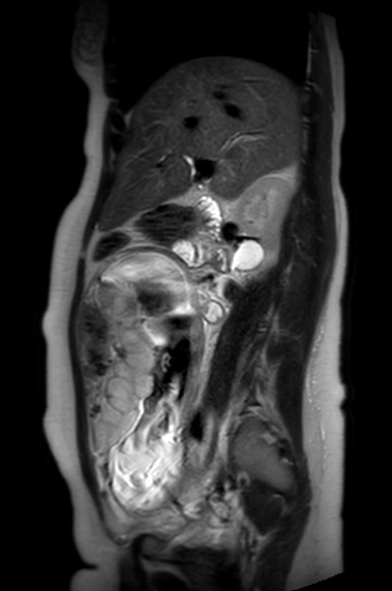 Appendicitis in gravida (MRI) (Radiopaedia 89433-106395 Sagittal T2 41).jpg