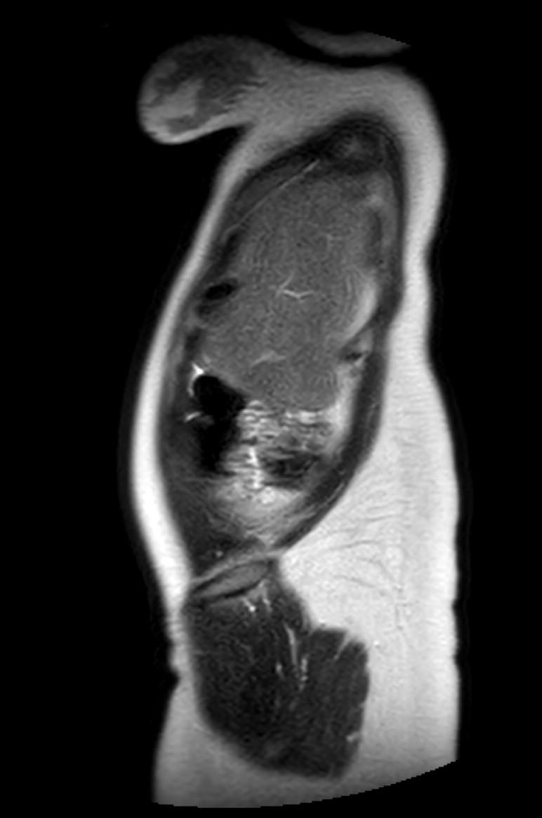 Appendicitis in gravida (MRI) (Radiopaedia 89433-106395 Sagittal T2 59).jpg