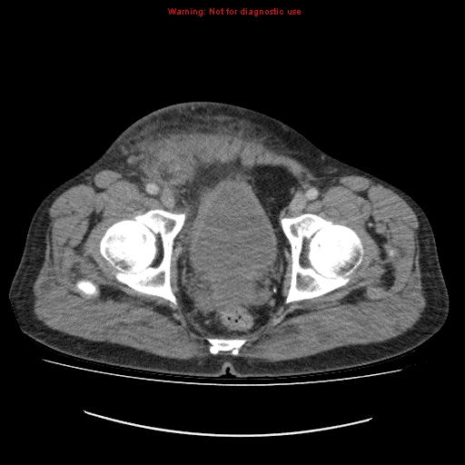 File:Appendicitis mass in inguinal hernia (Radiopaedia 26858-27029 A 25).jpg
