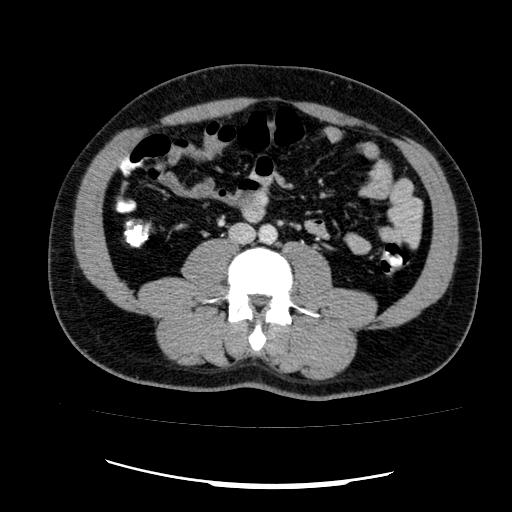 File:Appendicitis with diverticulosis (Radiopaedia 47693-52383 Axial C+ 78).jpg
