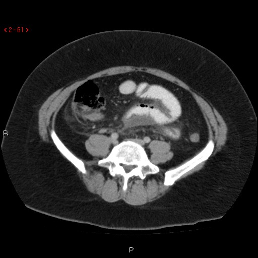 File:Appendicitis with microperforation- promontoric type (Radiopaedia 27268-27442 C 49).jpg