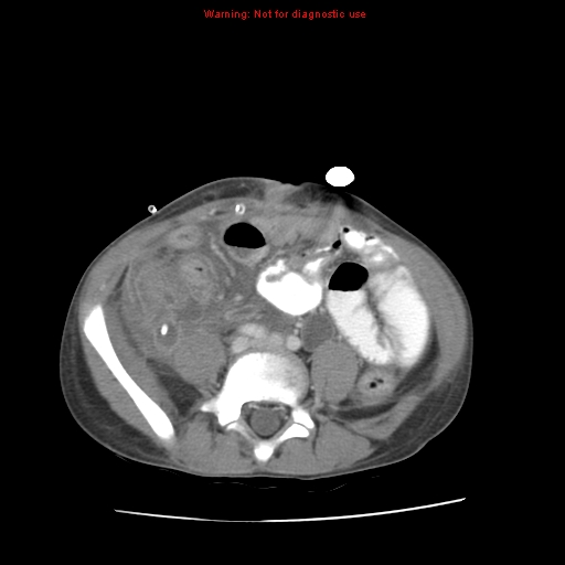 File:Appendicitis with phlegmon (Radiopaedia 9358-10046 A 47).jpg