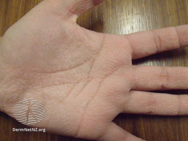 File:Aquagenic wrinkling of the palms (DermNet NZ reactions-agenic-wrinkling2).jpg