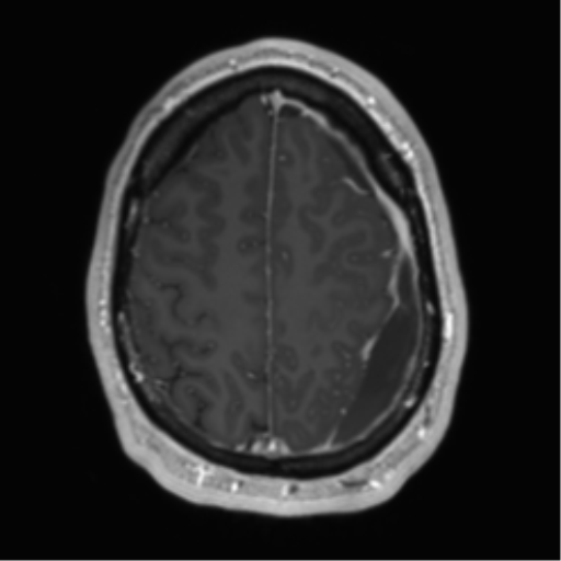 Arachnoid cyst with subdural hematoma (Radiopaedia 85892-101743 Axial T1 C+ 67).png