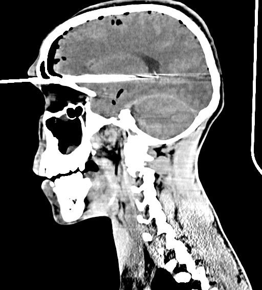 Arrow injury to the brain (Radiopaedia 72101-82607 H 40).jpg